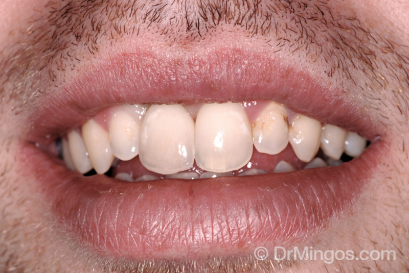 dental-implant-case-after