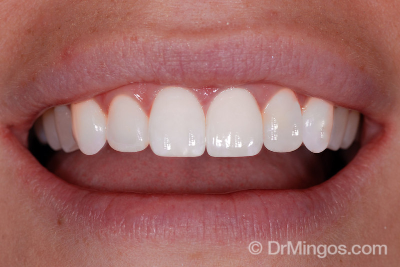 veneers-dentistry-after