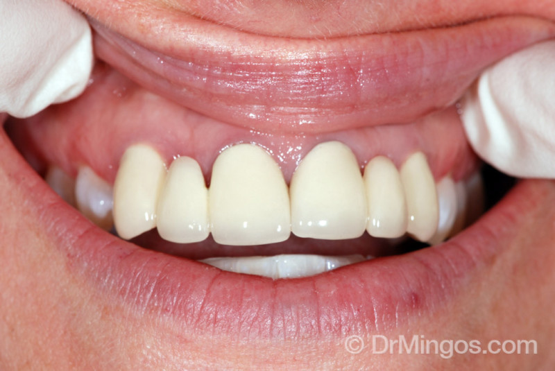 dental-bridge-teeth-before
