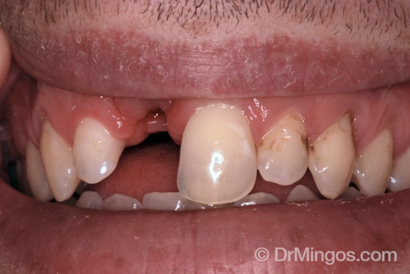dental-implant-case-before
