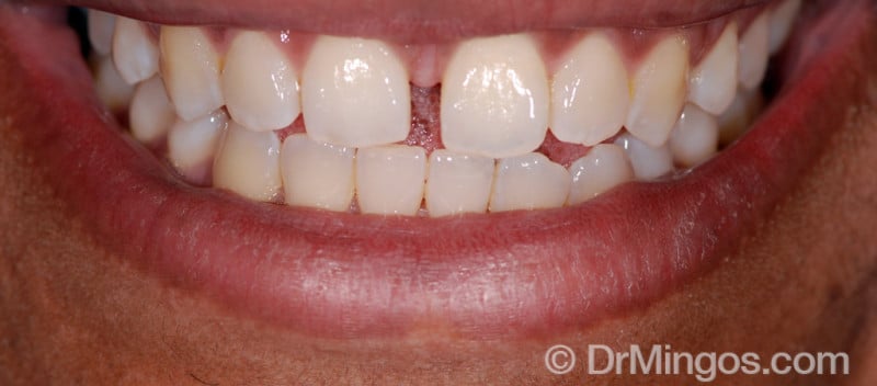 dentist-crowns-case-before