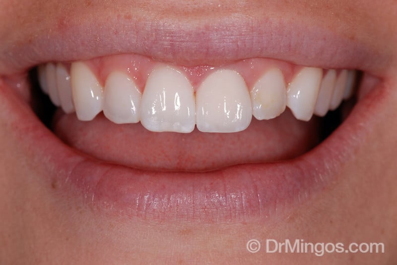 veneers-dentisrty-before